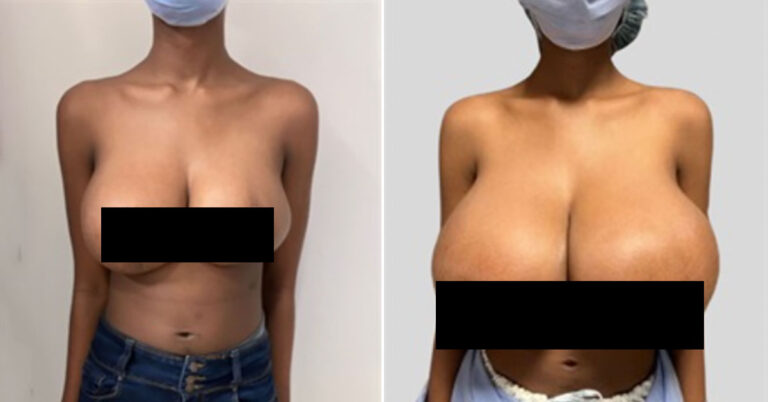 boob-nat